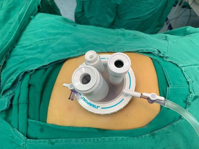 胃肠肛肠疝外科成功开展单孔腹腔镜下右半结肠癌根治手术